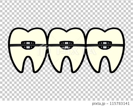 Orthodontics, illustration material of teeth undergoing correction 115783141