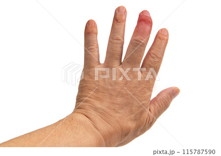 男性の手の中指に発症したヘバーデン結節 115787590