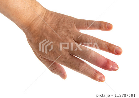 男性の手の中指に発症したヘバーデン結節 115787591