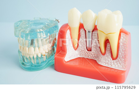 Dental implant, artificial tooth roots into jaw, root canal of dental treatment, gum disease, teeth model for dentist studying about dentistry. 115795629