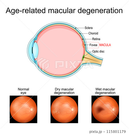 Age-related macular degeneration. Cross section of human eye 115801179
