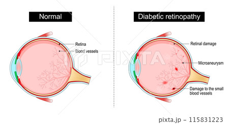 Diabetic retinopathy 115831223