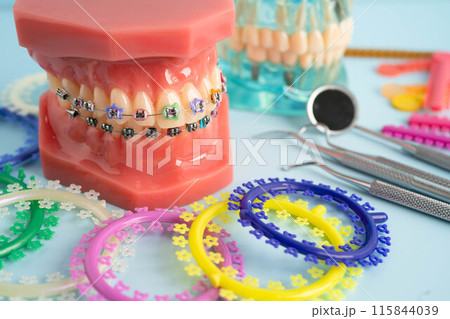 Orthodontic ligatures rings and ties, elastic rubber bands on orthodontic braces, model for dentist studying about dentistry. Orthodontic ligatures rings and ties, elastic rubber bands on orthodontic braces, model for dentist studying about dentistry. 115844039