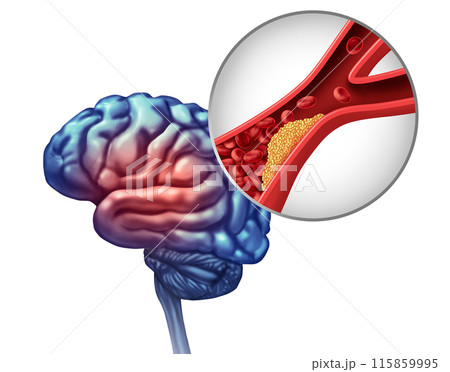 Mini Stroke 115859995