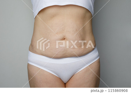Female skin with striae after pregnancy or overweight on white background 115860908