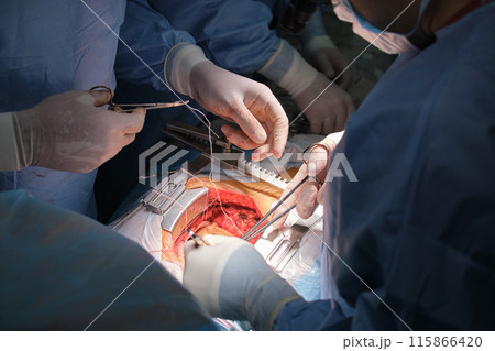 Closeup of professional doctor hands operating a patient during open heart surgery in surgical room. Healthcare and medical intervention concept 115866420