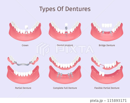 Dentures types. Tooth biting restorations dental care prosthesis teeth implant partial bridge complete full removable denture plastic crown, dentistry swanky illustration 115893171