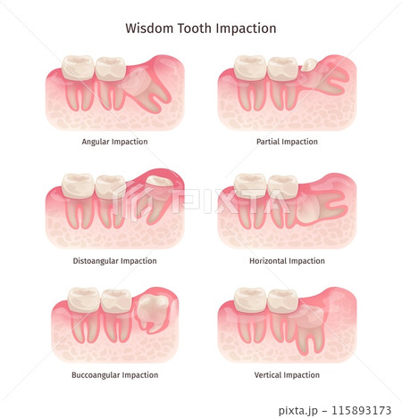 Wisdom tooth. Wisdoms teeth dental problem, molar extraction root canal bone or gum pain surgery treatment remove teeths dentist x ray infographic, swanky illustration Wisdom tooth. Wisdoms teeth dental problem, molar extraction root canal bone or gum pain surgery treatment remove teeths dentist x ray infographic, swanky illustration 115893173