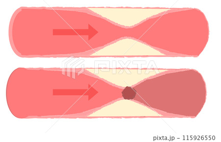 動脈硬化の進行 正常な血管 動脈硬化の進行 正常な血管 115926550
