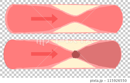 動脈硬化の進行 正常な血管 動脈硬化の進行 正常な血管 115926550