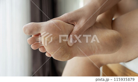 dirty and neglected feet dirty and neglected feet 115935879