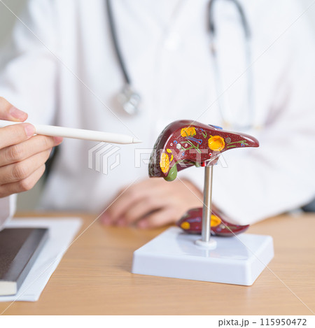 Doctor with human Liver anatomy model. Liver cancer and Tumor, Jaundice, Viral Hepatitis A, B, C, D, E, Cirrhosis, Failure, Enlarged, Hepatic Encephalopathy, Ascites Fluid in Belly and health concept Doctor with human Liver anatomy model. Liver cancer and Tumor, Jaundice, Viral Hepatitis A, B, C, D, E, Cirrhosis, Failure, Enlarged, Hepatic Encephalopathy, Ascites Fluid in Belly and health concept 115950472