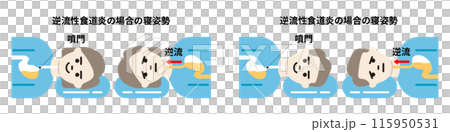 男性和女性胃酸逆流/逆流性食道炎的睡姿圖解 男性和女性胃酸逆流/逆流性食道炎的睡姿圖解 115950531