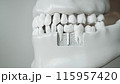 Dental Implant in Jaw 3D Rendering 115957420