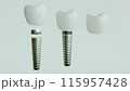 Dental Implants 3D Rendering 115957428