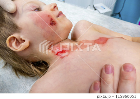 dressing a boy with a burn from boiling water dressing a boy with a burn from boiling water 115960053