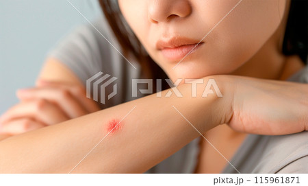 虫刺されに悩む女性の腕 115961871