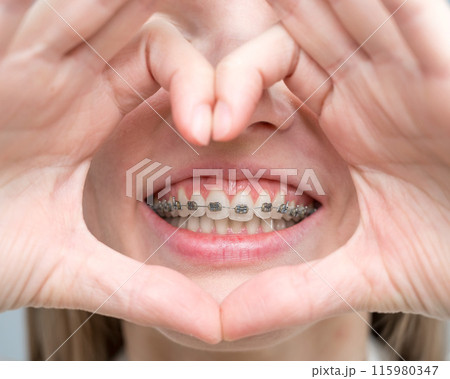 Caucasian woman in braces holding fingers in the shape of a heart.  115980347