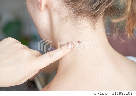 Woman examing her abnormal mole. Dermatology procedure. Doctor checking 115982102