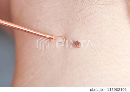 Woman examing her abnormal mole. Dermatology procedure. Doctor checking 115982103