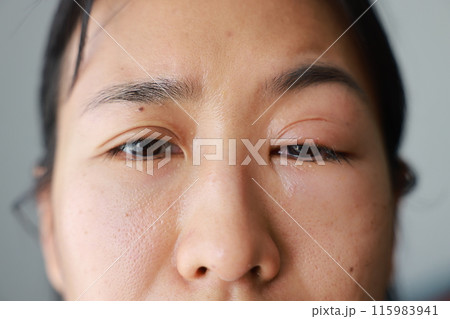 Woman's eyes become inflamed after rubbing her eyes violently. Insects entering eye cause irritation and wounds to cornea, causing eye to become swollen and red. Ophthalmologist treats eye infections. 115983941