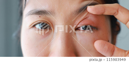 Woman's eyes become inflamed after rubbing her eyes violently. Insects entering eye cause irritation and wounds to cornea, causing eye to become swollen and red. Ophthalmologist treats eye infections. Woman's eyes become inflamed after rubbing her eyes violently. Insects entering eye cause irritation and wounds to cornea, causing eye to become swollen and red. Ophthalmologist treats eye infections. 115983949