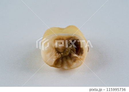 抜歯された歯と白背景 抜歯された歯と白背景 115995736