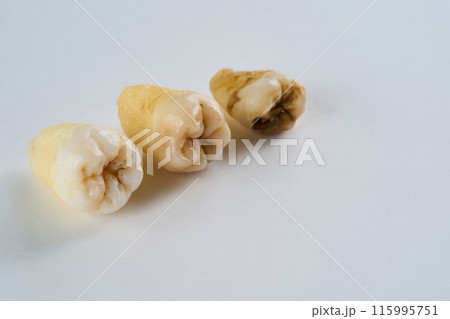 抜歯された歯と白背景 115995751