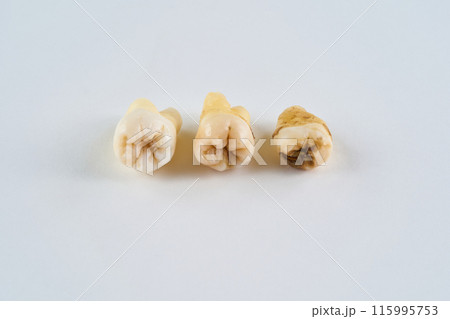 抜歯された歯と白背景 抜歯された歯と白背景 115995753