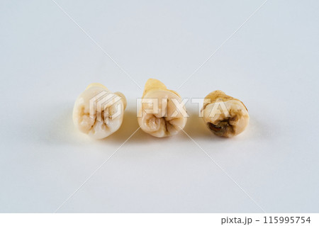 抜歯された歯と白背景 115995754