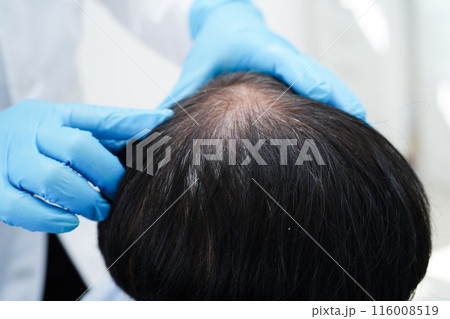 Doctor touch bold head in man, hair loss treatment health problem. 116008519