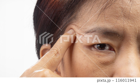 The ptosis or droopy eyelids in asian senior woman. The ptosis or droopy eyelids in asian senior woman. 116011941
