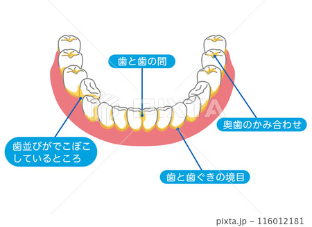 歯垢が残りやすいところ 歯磨き 磨き残し 歯垢が残りやすいところ 歯磨き 磨き残し 116012181