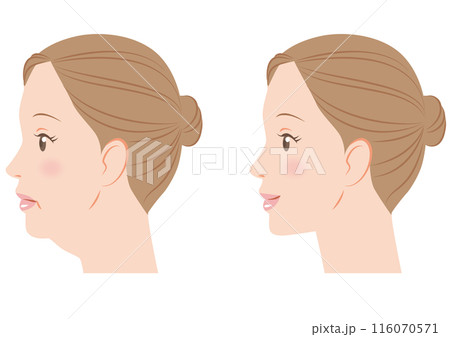 あごのたるみ あごのたるみ 116070571