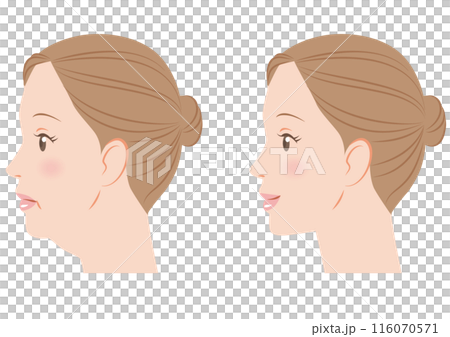 あごのたるみ あごのたるみ 116070571