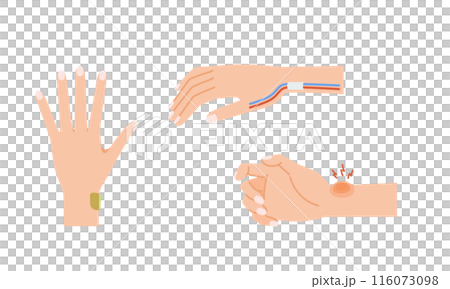 女性の更年期障害：ドケルバン病のイメージイラストセット 116073098