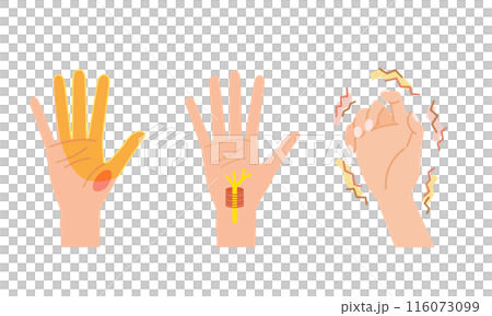 Menopausal disorder in women: Carpal tunnel syndrome image illustration set Menopausal disorder in women: Carpal tunnel syndrome image illustration set 116073099