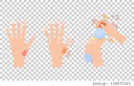 女性更年期：拇指 CM 關節病圖像插圖集 116073101