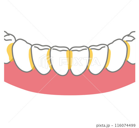 歯と歯の間に溜まった歯垢 歯磨き 磨き残し 歯と歯の間に溜まった歯垢 歯磨き 磨き残し 116074499