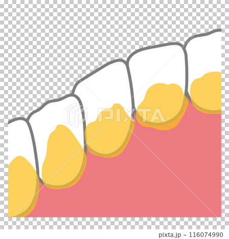 Plaque accumulated on the back of the front teeth, toothbrushing, unbrushed areas 116074990