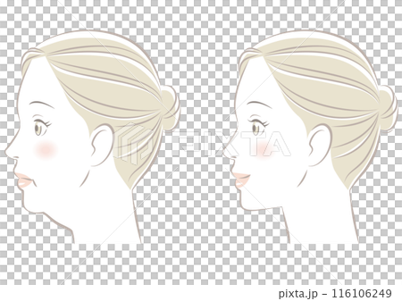 あごのたるみ 116106249