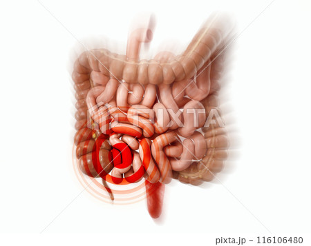3d illustration of sick human intestine 116106480