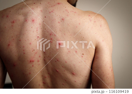 A rash of red dots and blisters on a man's back. Chickenpox is much more severe in adults. 116109419