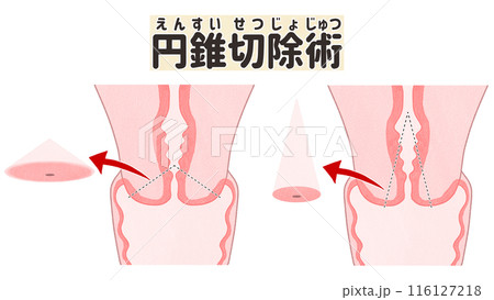 円錐切除術　子宮頸がん　わかりやすい日本語図解イラスト 116127218