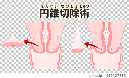 Cone biopsy - Cervical cancer - Easy-to-understand Japanese illustrations 116127218