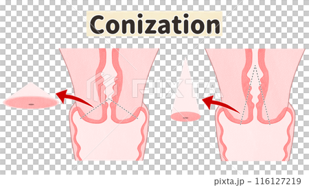 円錐切除術　子宮頸がん　わかりやすい英語図解イラスト 116127219
