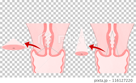 子宮頸錐狀切除術 簡單易懂的插圖 子宮頸錐狀切除術 簡單易懂的插圖 116127220