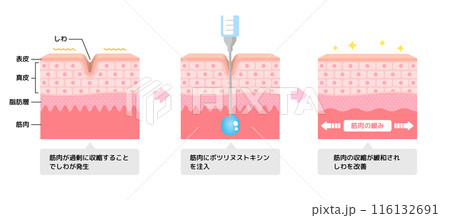 ボトックス注射 (ボツリヌストキシン）によるシワ取りのメカニズム / ベクター図解イラスト 116132691