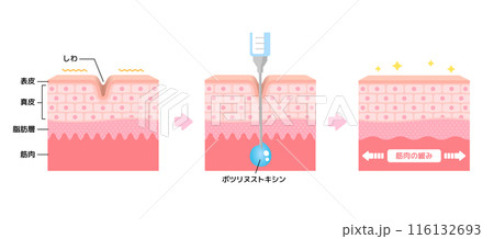 ボトックス注射 (ボツリヌストキシン)によるシワ取りのメカニズム / ベクター図解イラスト ボトックス注射 (ボツリヌストキシン)によるシワ取りのメカニズム / ベクター図解イラスト 116132693