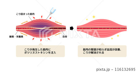 ボトックス注射 (ボツリヌストキシン）によるこりの緩和のメカニズム / ベクター図解イラスト 116132695